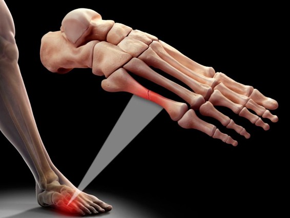 Fracturas por estrés