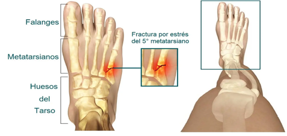 Fractura del quinto metatarsiano