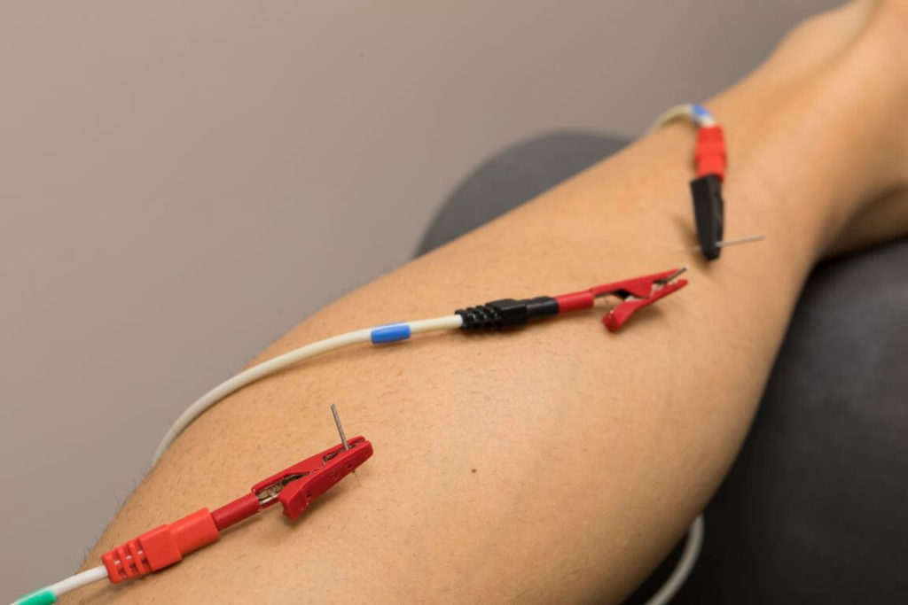 Neuromodulación en el Cañaveral