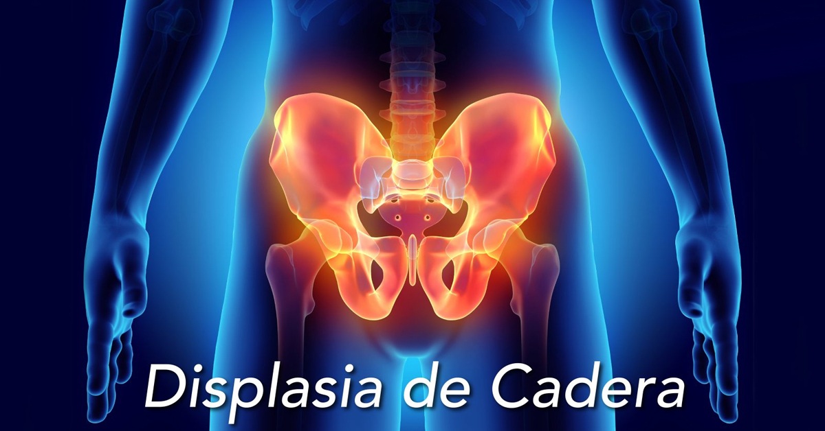 Displasia de cadera, en El Cañaveral